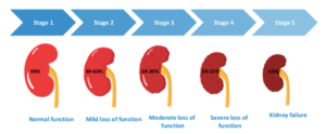 kidney failure stages